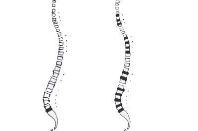 View of spine using CAT scan next to the more precise BEV Test view.