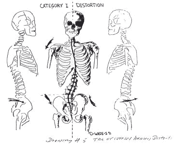 Category 1 distortion of the spine.