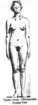 Illustration of an anterior view of a woman with triggerpoints indicated with 
							bullets.